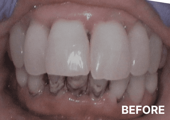 before-11
