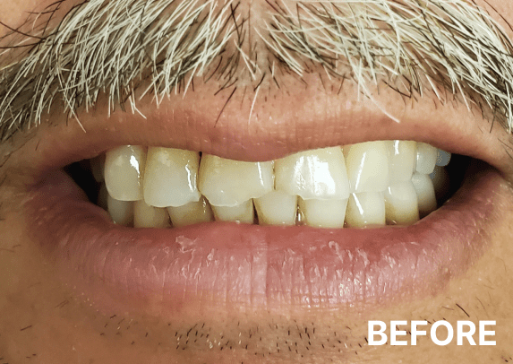 before-2 before-2