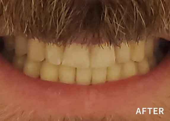Patient13-after