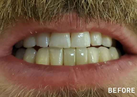 Patient13-before