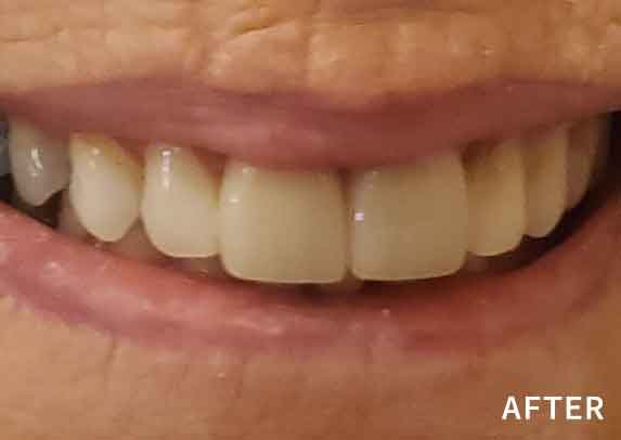 Patient14-after