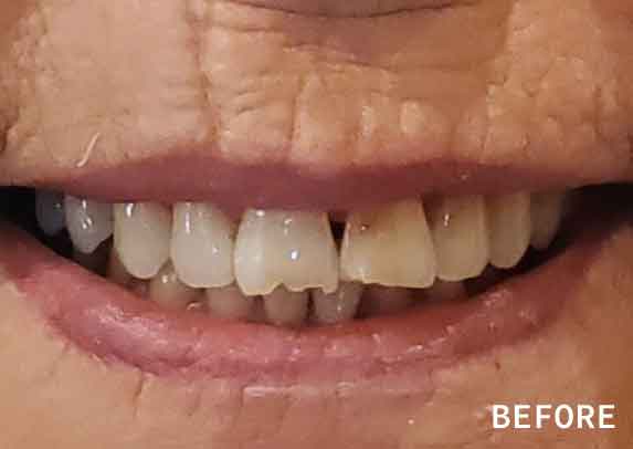 Patient14-before