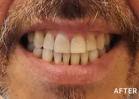 Patient15-after