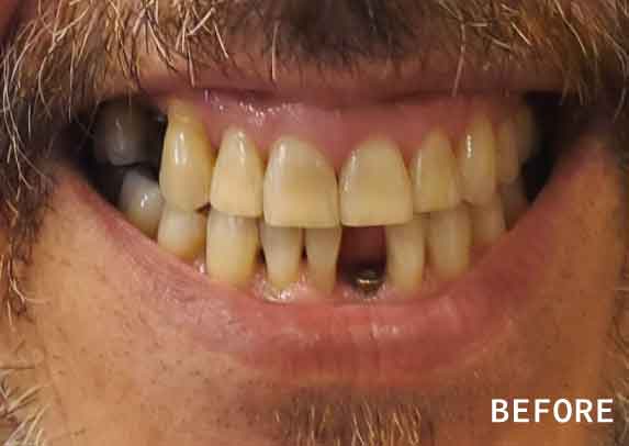 Patient15-before